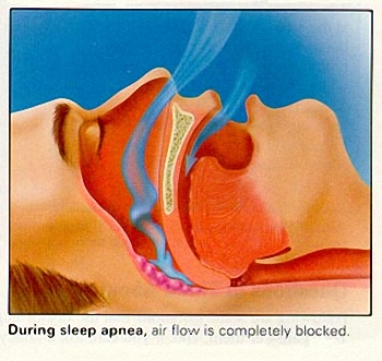 [iPhone-App]-Sleep-Aid---Ứng-dụng-dành-cho-những-người-ngủ-ngáy